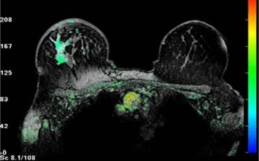 MRI image for breast cancer staging post